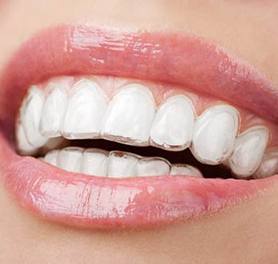 Orthodontic Treatment